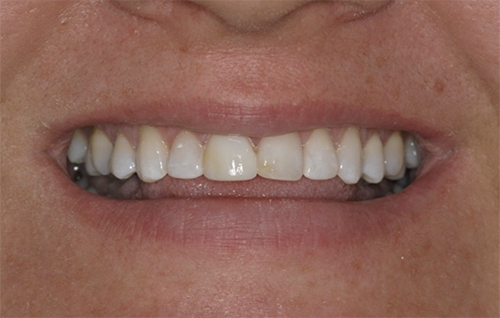 After dental treatment