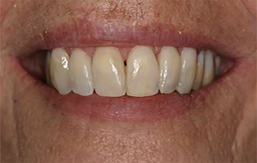 After dental treatment