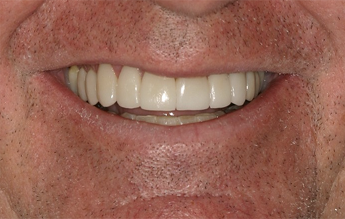 After dental treatment