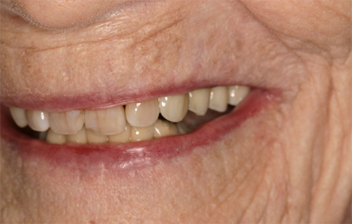After dental treatment
