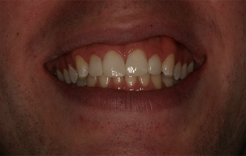 After dental treatment