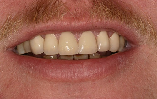 After dental treatment