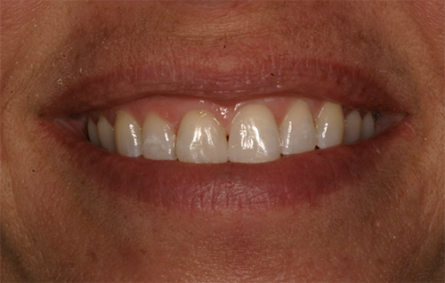After dental treatment