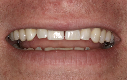 After dental treatment