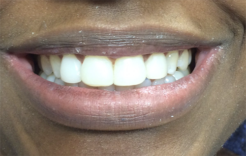 After dental treatment