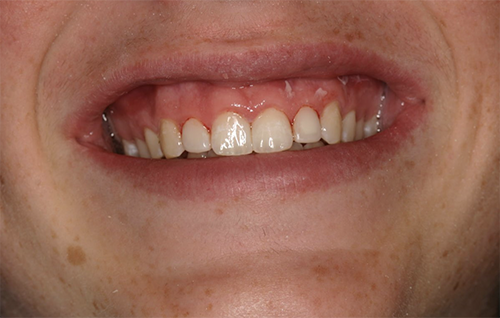 After dental treatment