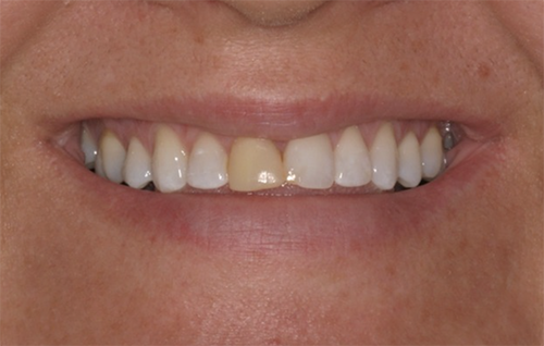 Before dental treatment