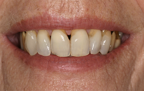 Before dental treatment