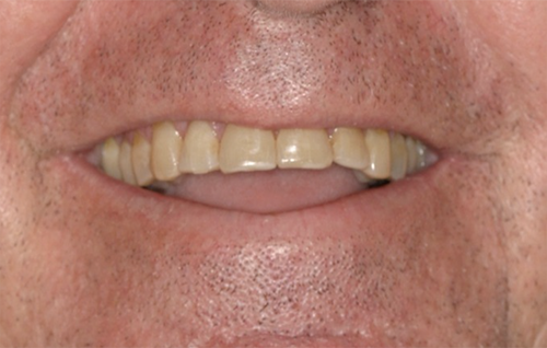 Before dental treatment