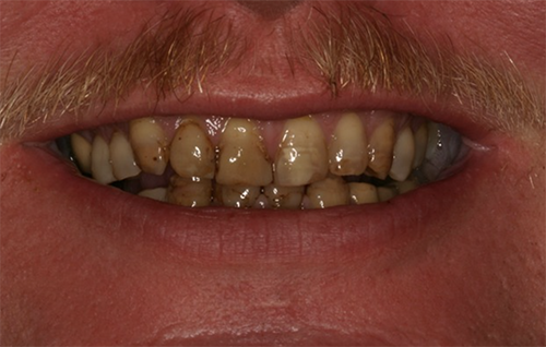 Before dental treatment