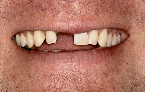 Before dental treatment