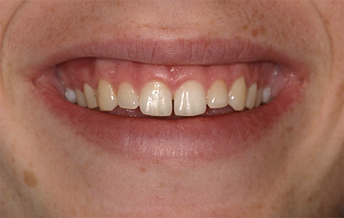Before dental treatment